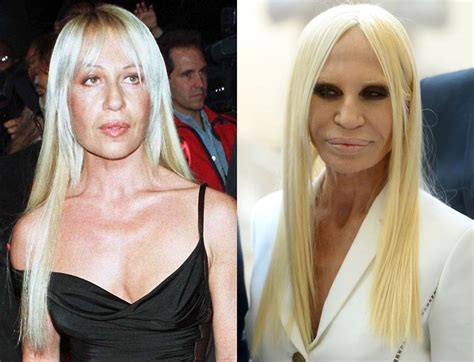 blue donatella versace|donatella versace before and after surgery.